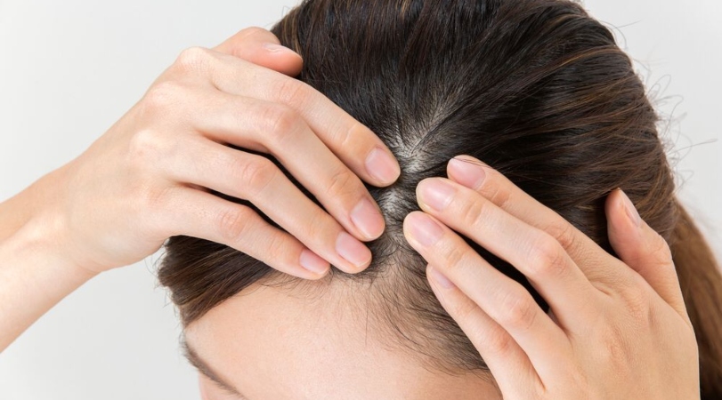 Kulit Kepala Sehat Jadi Kunci Utama Gaya Hidup Modern