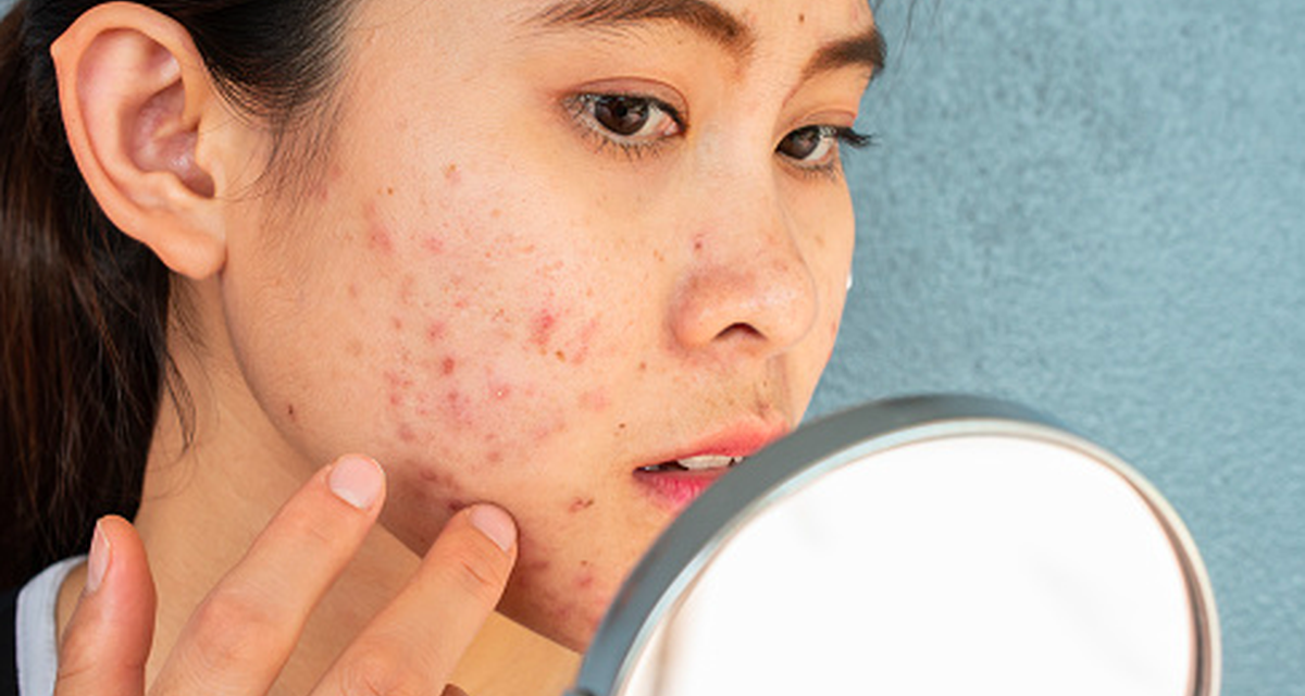 Ciri Skin Barrier Rusak Akibat Gonta-Ganti Skincare Viral