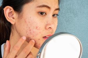 Ciri Skin Barrier Rusak Akibat Gonta-Ganti Skincare Viral