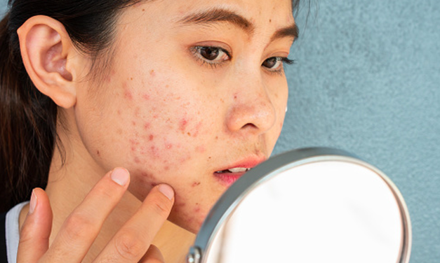 Ciri Skin Barrier Rusak Akibat Gonta-Ganti Skincare Viral